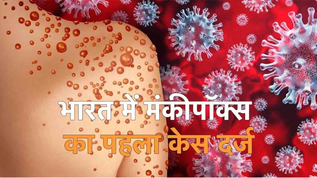 Monkeypox In India Khabritota.in